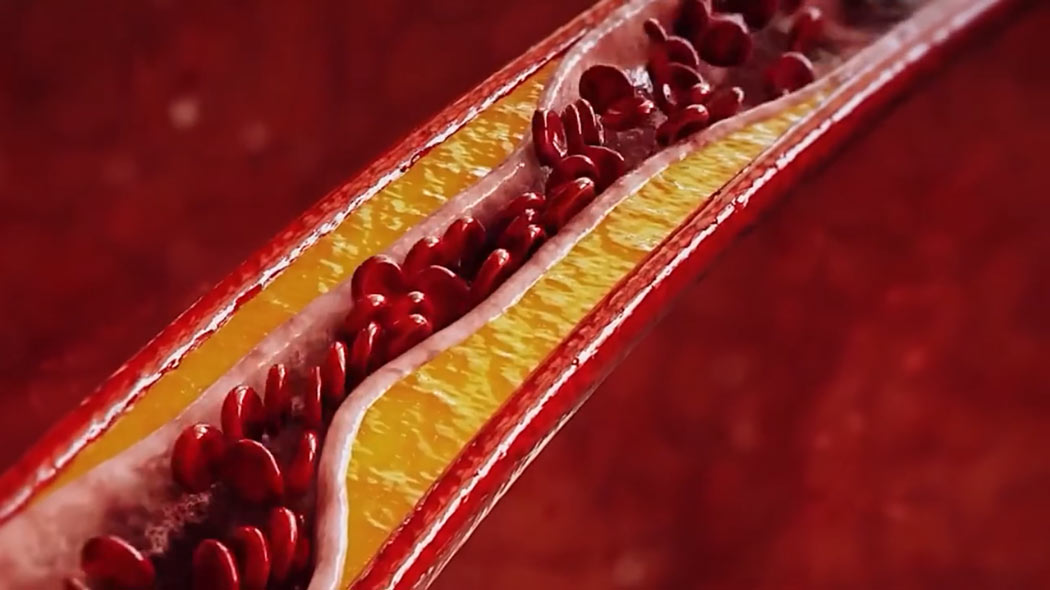bloodflow